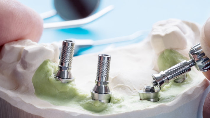 The Impact of Lifestyle Habits on the Success of Dental Implants