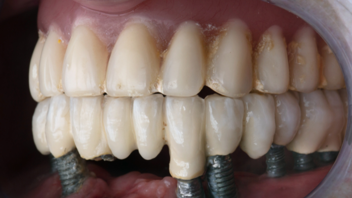 Dental implants for the elderly in Morocco