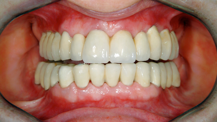 Dental implants and facial reconstruction after trauma