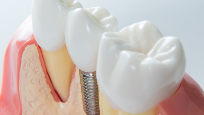 Dental Implants and Solving Bite and Alignment Problems