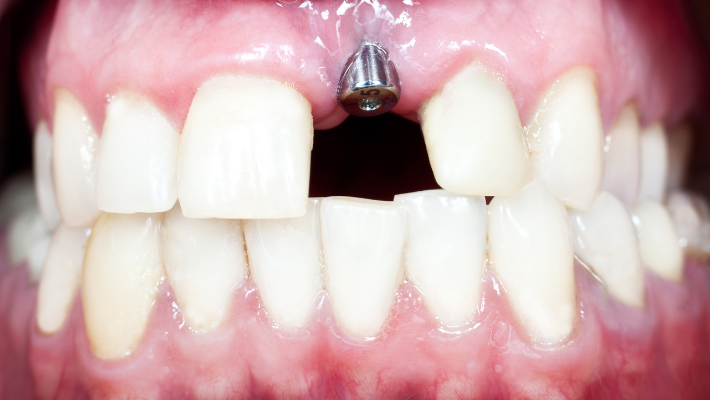 How to Maintain Your Dental Implants for Maximum Longevity