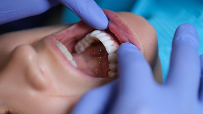 Dental Veneers and Cavities: How to Avoid Future Problems?