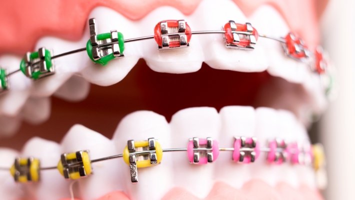 Dental veneers after orthodontic treatment, when to consider them?