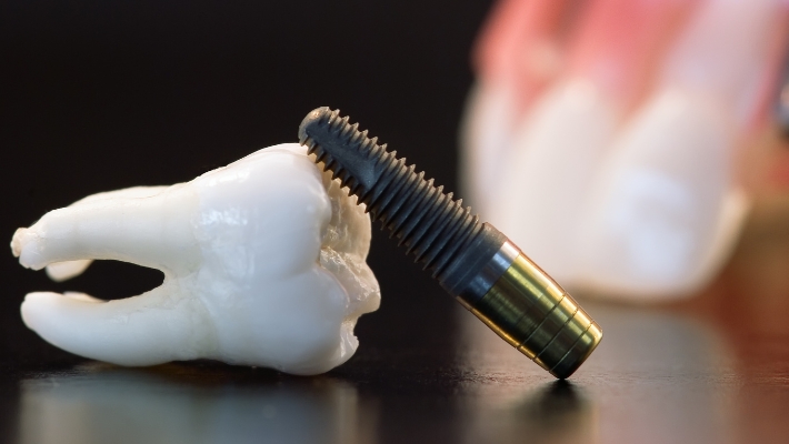 How is treatment carried out with miniature dental implants? 