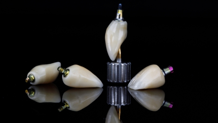 The importance of dental implants for oral health  