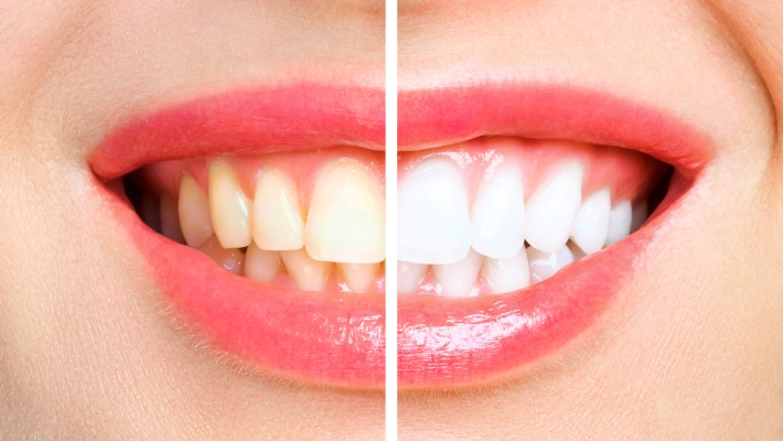 Teeth Whitening and Salivation Disorders