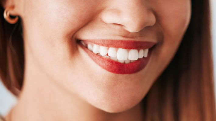 How long do dental veneers last?