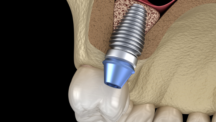 Dental Implants and Maxillary Sinus: Sinus Lift Precautions and Techniques