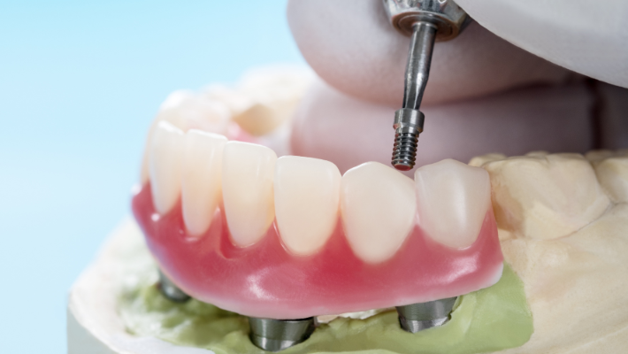 Dental implants in the treatment of cancer patients