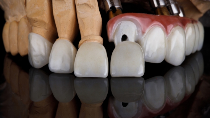 Durability of Dental Veneers: What You Need to Know