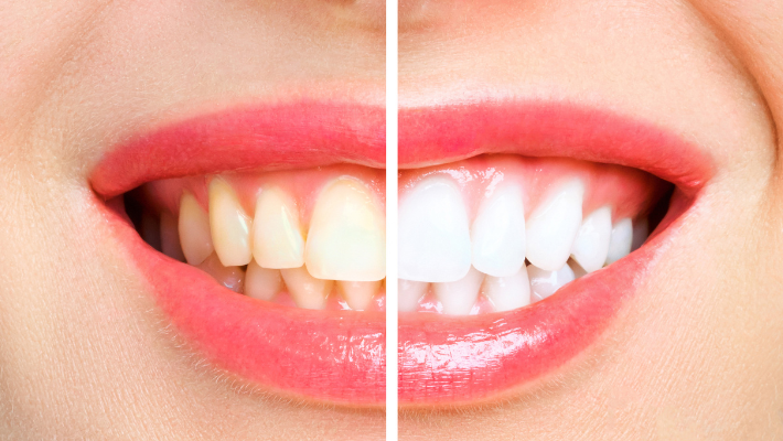 Tooth whitening for stained teeth in Marrakech