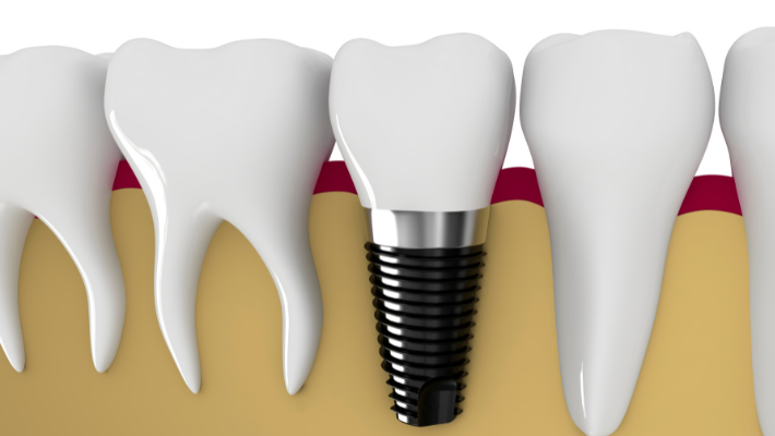 Dental implants for people who have lost a tooth in Marrakech