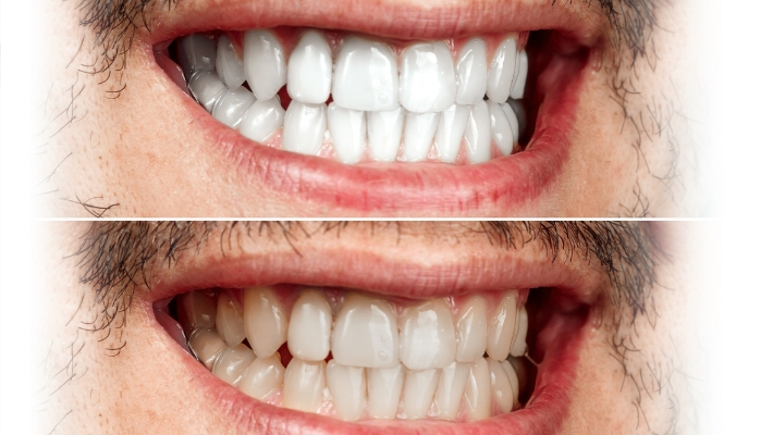 The Power of Teeth Whitening  