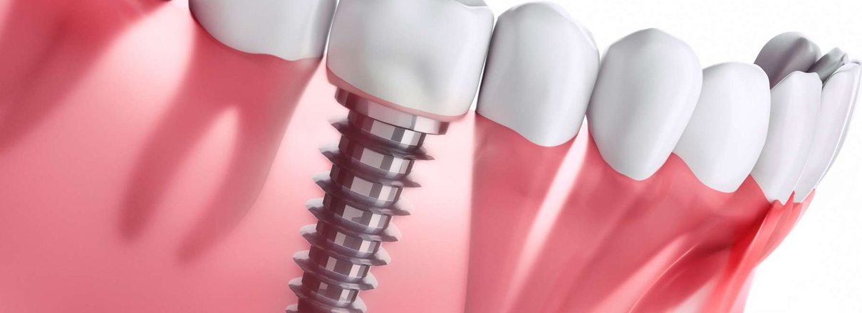 Dental implants